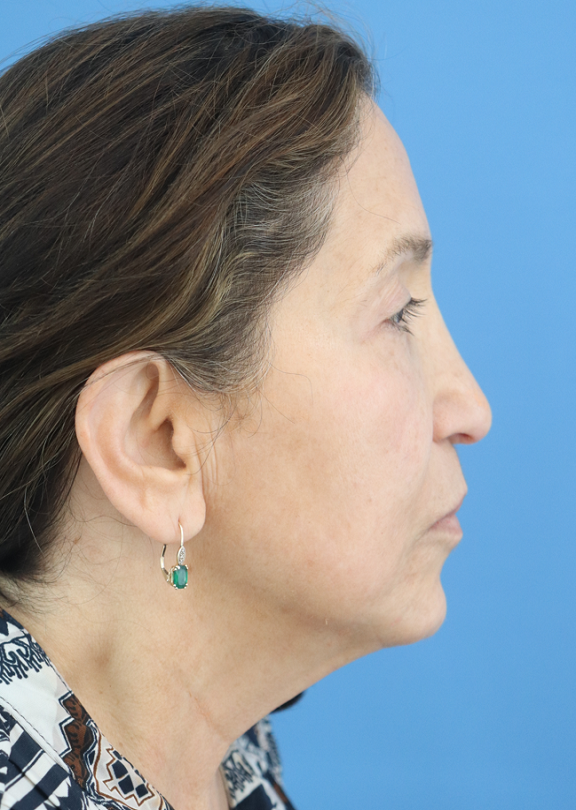 Facelift Before & After Gallery - Patient 418529 - Image 1
